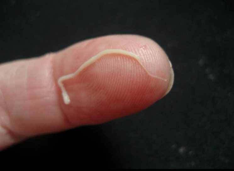 parásito nematodo del cuerpo humano